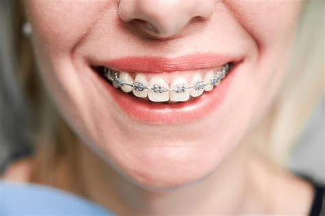 precio brackets metalicos ortodoncia|what are brackets in braces.